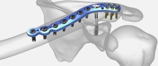 bone plate