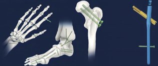 BONE SCREW