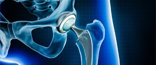 HIP SYSTEM