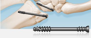 LOCKING BONE SCREW