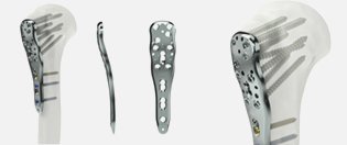 locking-plate